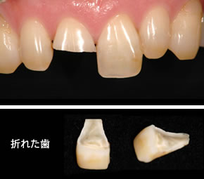 治療前の口腔内と折れた歯