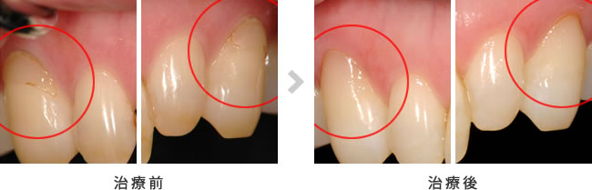 ダイレクトボンディングの治療前後