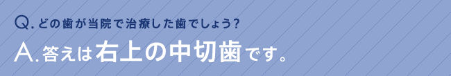 どの歯が当院で治療した歯でしょう？答えは右上の中切歯です。