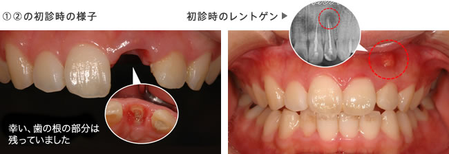 初診時の口腔内正面写真