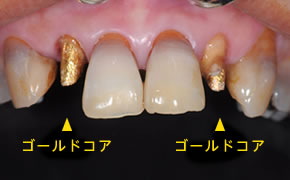 ゴールドコア植立イメージ